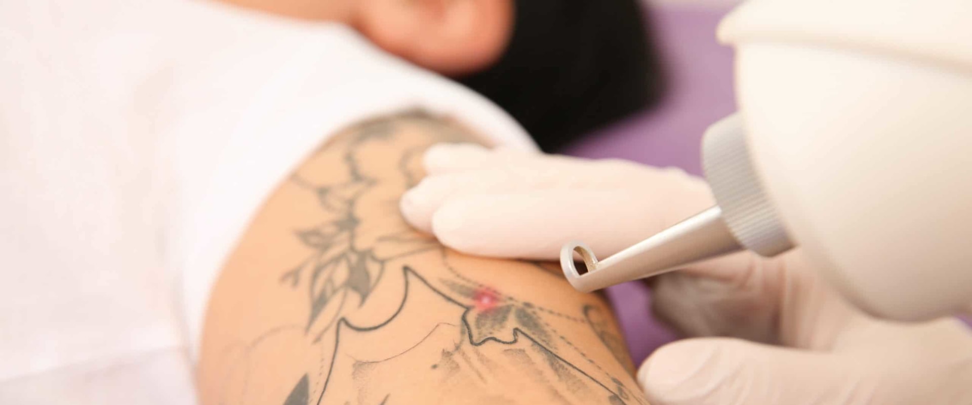 The Complete Guide to Q-Switched Laser Removal for Unwanted Tattoos