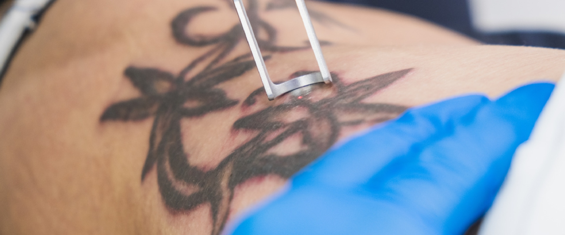 Application Tips and Techniques for Tattoo Removal