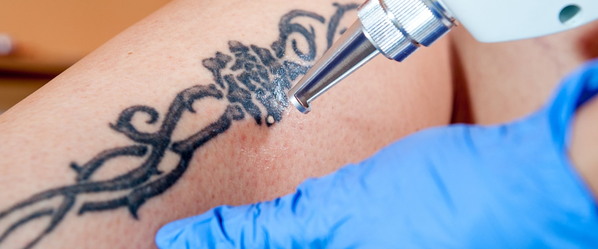 Working with an Experienced Artist: A Guide to Tattoo Removal Options