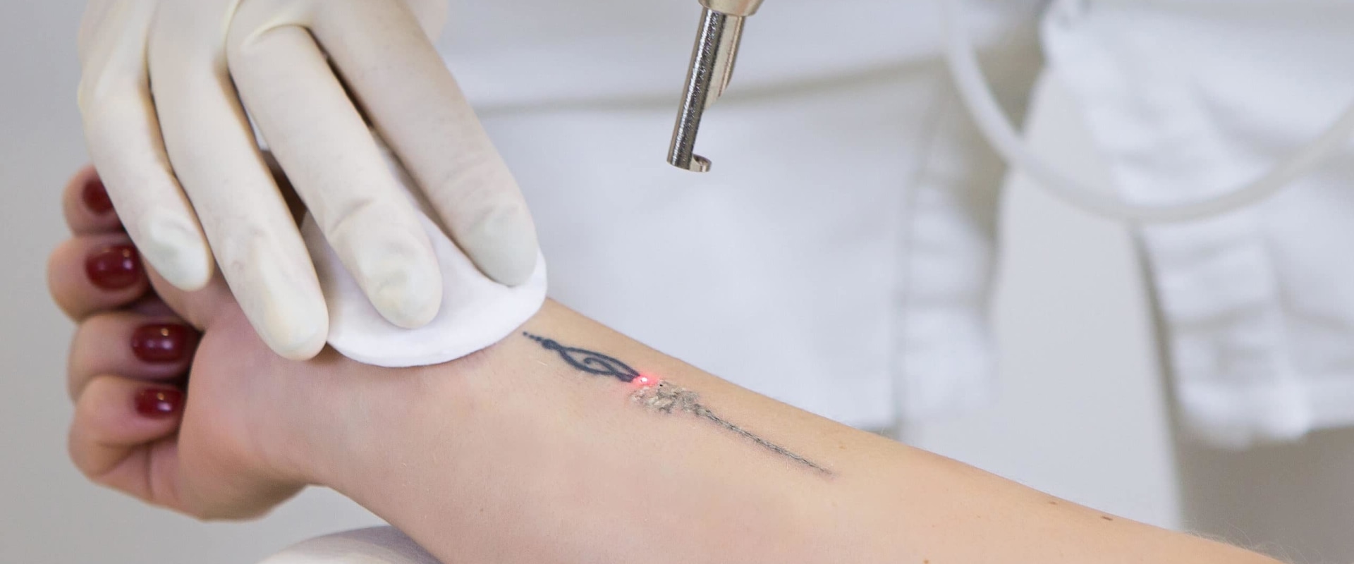 Recovery Process: How to Effectively Remove Unwanted Tattoos