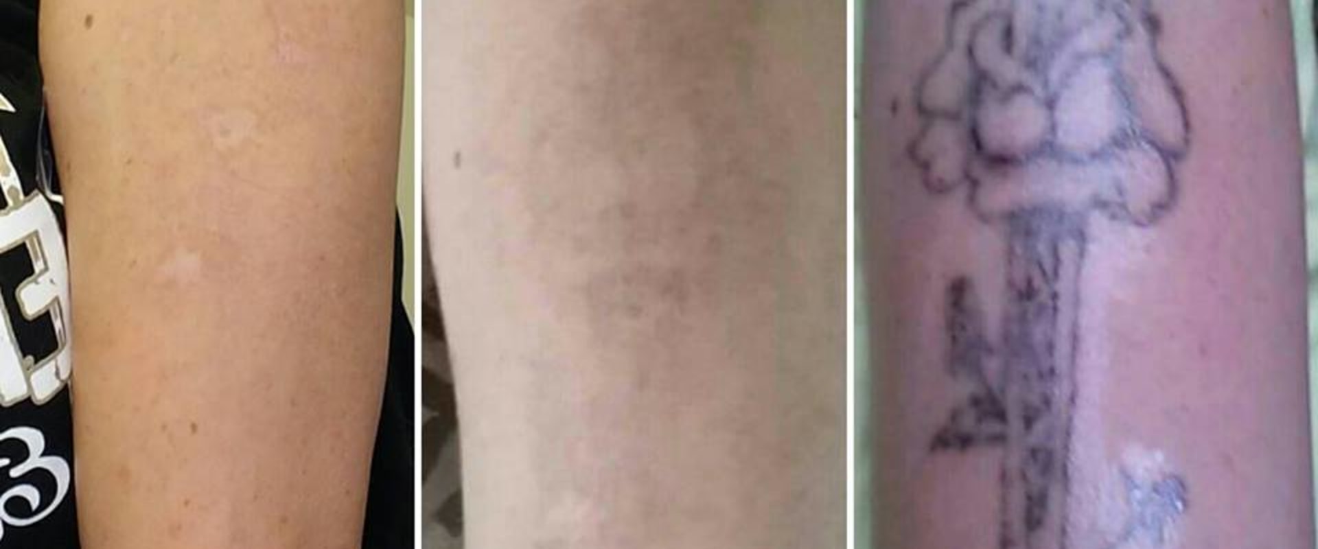 Layering Techniques for Coverage: How to Effectively Remove Unwanted Tattoos