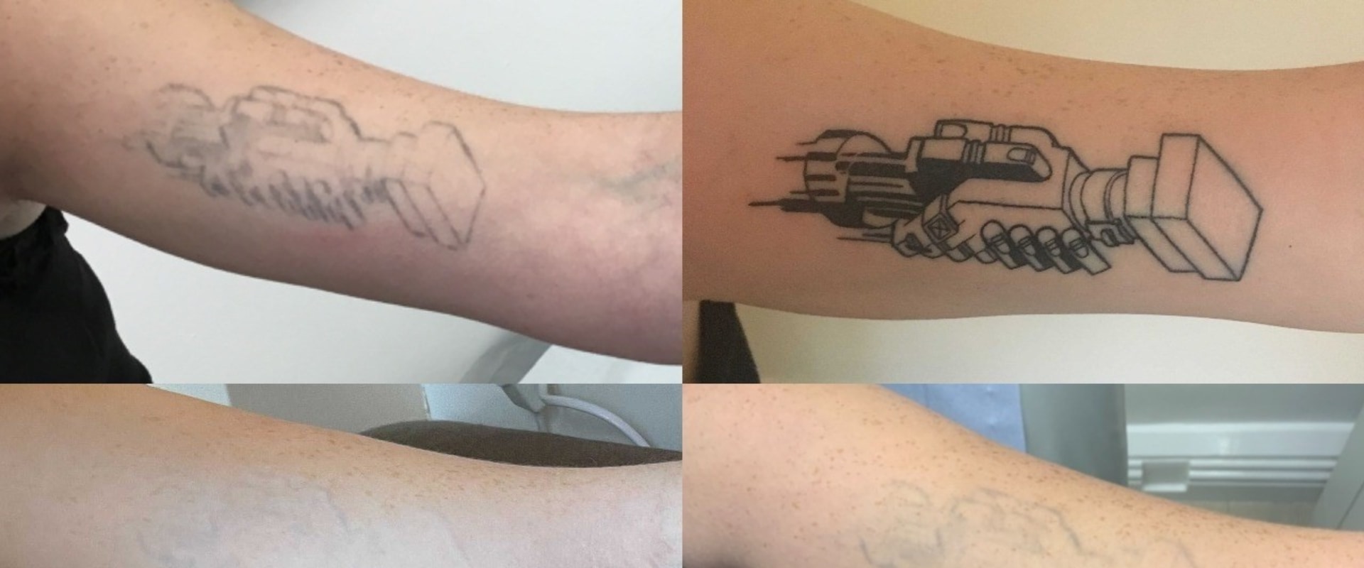 Exploring the Long-term Costs of Tattoo Removal