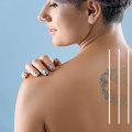 Preventing Scarring: A Comprehensive Look at Tattoo Removal