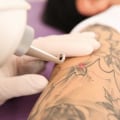 The Complete Guide to Q-Switched Laser Removal for Unwanted Tattoos