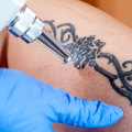 Working with an Experienced Artist: A Guide to Tattoo Removal Options