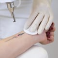 Recovery Process: How to Effectively Remove Unwanted Tattoos