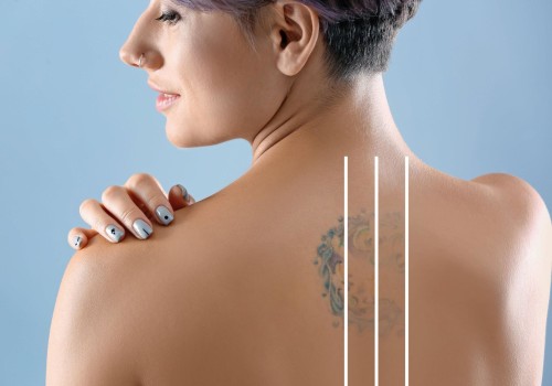 Preventing Scarring: A Comprehensive Look at Tattoo Removal