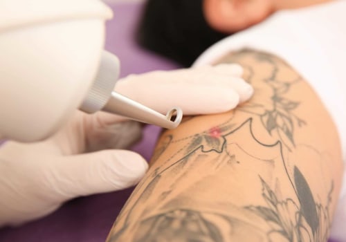 The Complete Guide to Q-Switched Laser Removal for Unwanted Tattoos