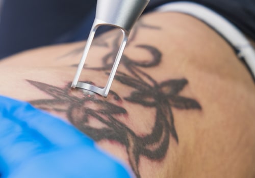 Application Tips and Techniques for Tattoo Removal