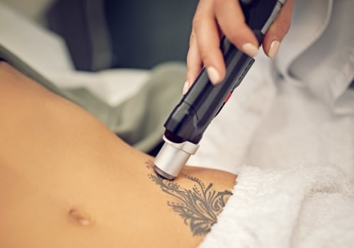 A Comprehensive Guide to Tattoo Removal: Cost, Risks, and Alternatives