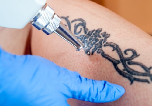 Working with an Experienced Artist: A Guide to Tattoo Removal Options