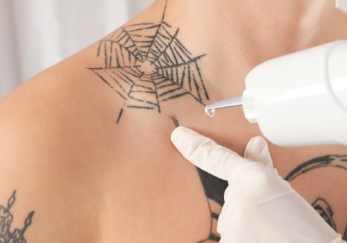 A Comprehensive Guide to Understanding Potential Risks and Complications of Tattoo Removal