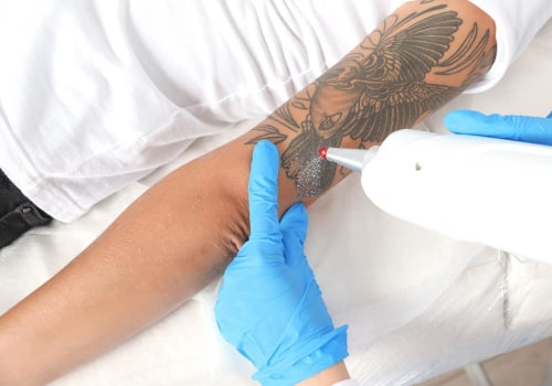 The Importance of Following Aftercare Instructions for Tattoo Removal