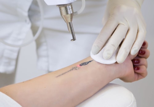 Recovery Process: How to Effectively Remove Unwanted Tattoos