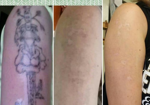 Layering Techniques for Coverage: How to Effectively Remove Unwanted Tattoos