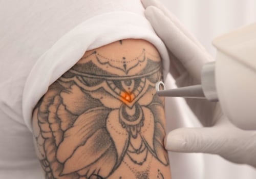 How to Get Rid of Unwanted Tattoos: A Comprehensive Guide to Tattoo Removal